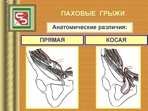 Как отличить косую паховую грыжу от прямую - 90 фото