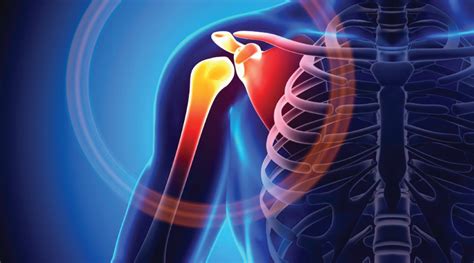 What Is Shoulder Impingement And How Can Chiropractic Care Help Bonus