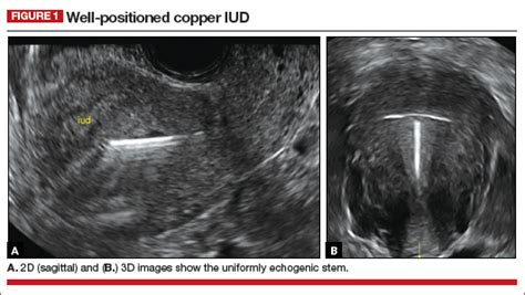 How To Identify And Localize Iuds On Ultrasound Mdedge Obgyn