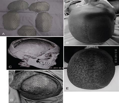 Use Of Stock Titanium Mesh Plates In Cranioplasty Journal Of