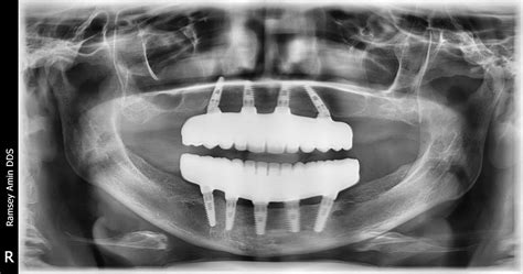 The All on 4 Dental Implants Process