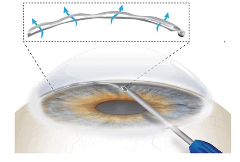 Les Microshunts à Glaucome Glaucometech