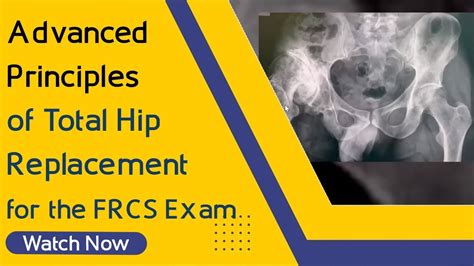 Advanced Principles Of Total Hip Replacement For The FRCS Exam