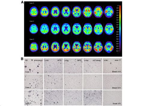 A Flortaucipir Pet Images Premortem Evaluation Of Tau Flortaucipir