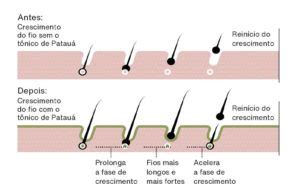 Queda De Cabelo Entenda As Principais Causas E Saiba Como Tratar