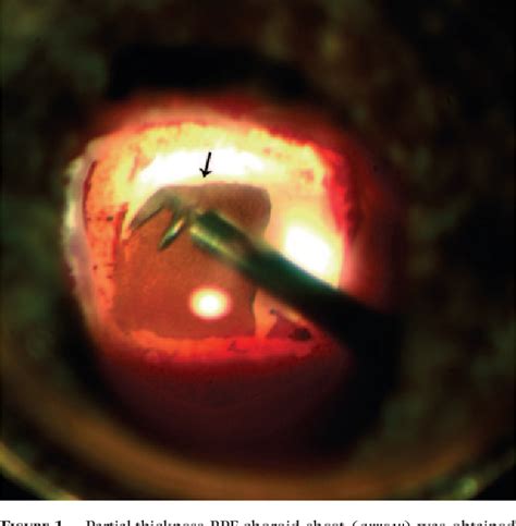 Figure 1 From Autologous Transplantation Of RPE With Partial Thickness