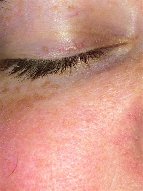 White Bump On Eyelid Eyelid Bumps 101 How To Identify Styes Milia