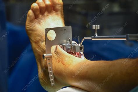 Screw Removal After Ankle Surgery At Nicholas Torres Blog