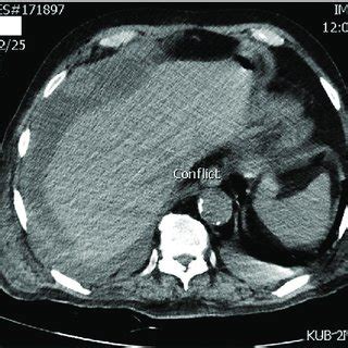 Outcomes of patients after percutaneous cholecystostomy | Download Scientific Diagram