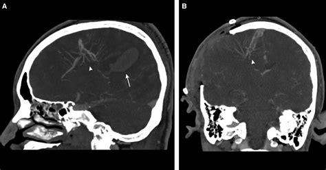 COVID 19 Associated Cerebral Developmental Venous Anomaly Thrombosis