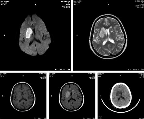 典型病例分析脑梗死中t Wi高信号的 点解释 铁岭市中心医院 Sexiezpix Web Porn