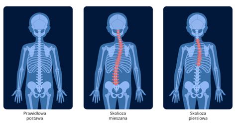 Wady Postawy U Dzieci Rodzaje Przyczyny Leczenie