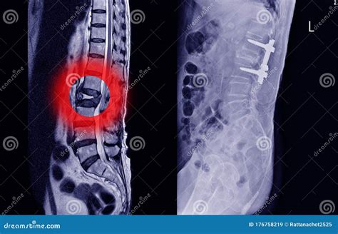 Medical X-ray Lumbar Spine Compression Fracture Bulging of L1-2 Stock ...