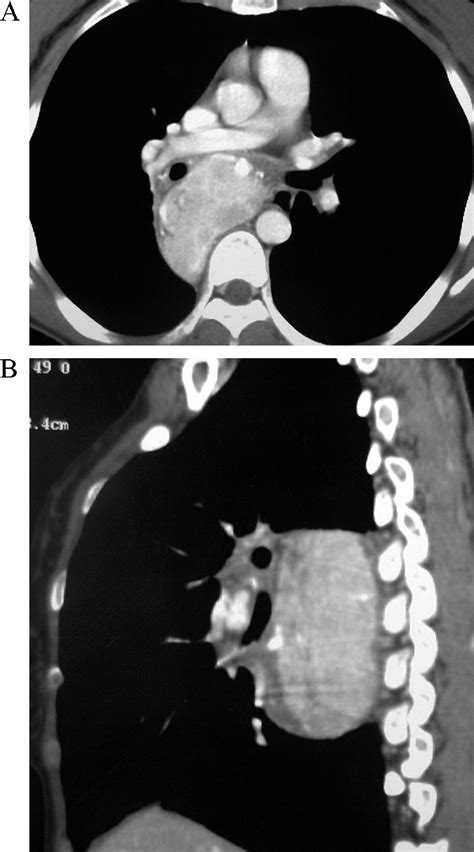 The Value Of Mdct In Diagnosis Of Hyaline Vascular Castleman S Disease