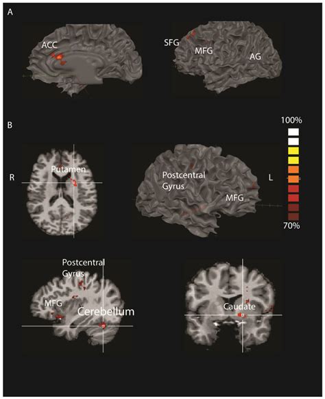 Multi Voxel Pattern Analysis Of Brain Activations Related To CET