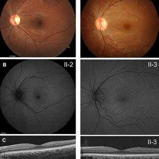 Coexistence Of Gnat And Abca Variants Associated With Nougaret Type