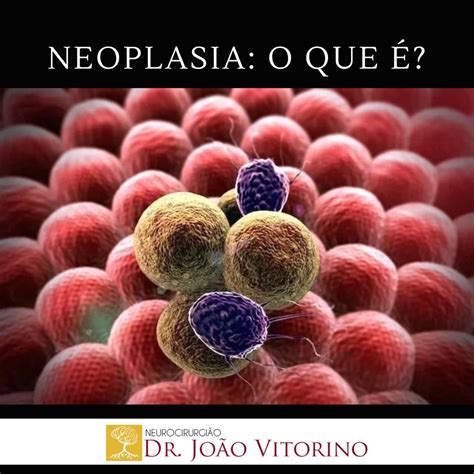 Neoplasia o que é Neurocirurgião em São Paulo Especialista em