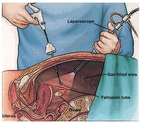 Laparoscopic Surgery For Endometriosis Statesboro Womens Health Specialists