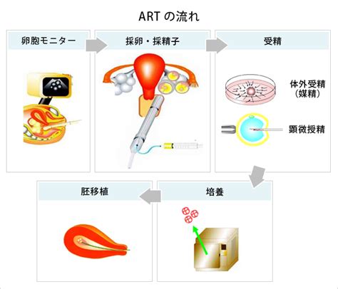 採卵～体外受精or顕微授精～胚移植 セントマザー産婦人科医院