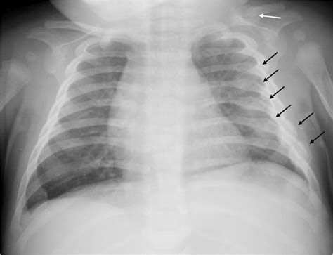 Slightly Rotated Anteroposterior Chest Radiograph Of Six Healing Rib