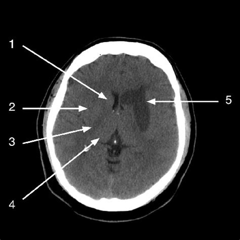 Infarction: Internal Capsule Infarct