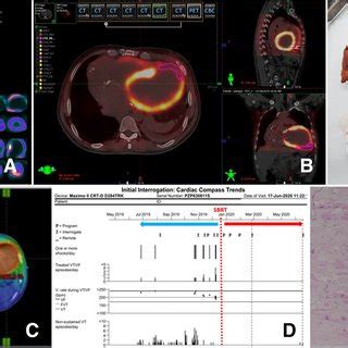 Electrophysiological Study And Mapping Data In Case 1 A During