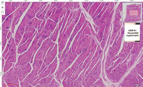 Myocardial Hypertrophy Section Um H E Stain University Standard