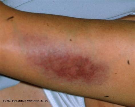 Lupus Erythematosus- Profundus | Department of Dermatology