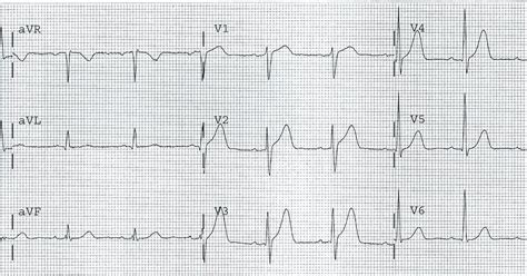 Dr Smiths Ecg Blog Acute Mi From Lad Occlusion Or Early Repolarization