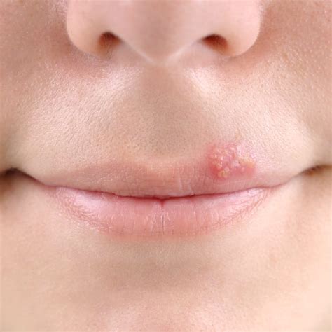 Staph Infection On Lips