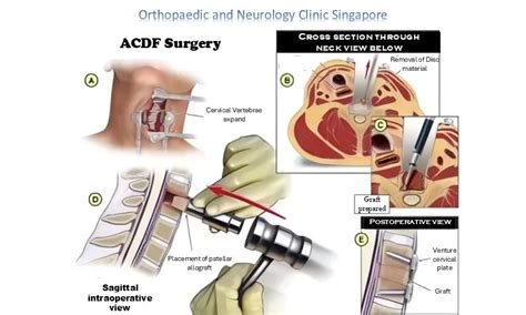 ACDF Surgery Spine | Anterior Cervical Discectomy and Fusion