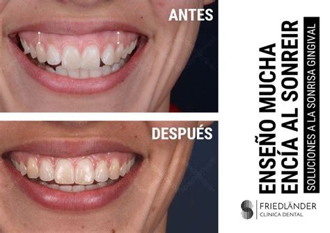 Porqué cuando sonríes enseñas la encía Clínica dental Friëdlander