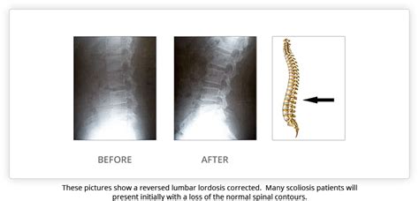 Scoliosis Treatment Results Strauss Scoliosis Correction