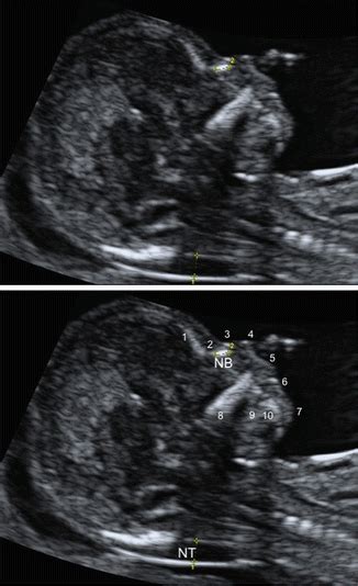 Evaluation Of The Fetal Face In The First Trimester Radiology Key