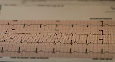 Stress test (Stress ECG) | Heartcare Sydney