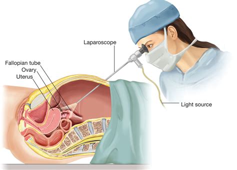 What Is Laparoscopic Surgery And How It Is Performed Broowaha Fibroid Surgery Uterine