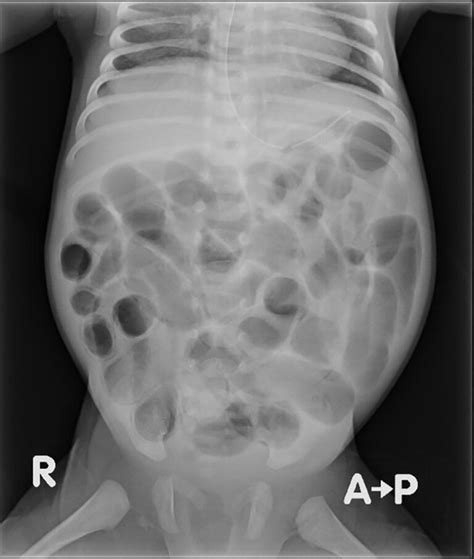 An Approach To Distended Abdomens In Neonates Don T Forget The Bubbles