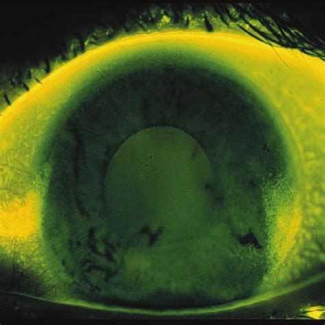 Pdf Corneal Staining As A Response To Contact Lens Wear