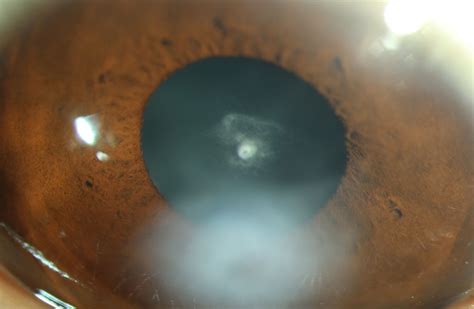 Anterior Capsular Cataract