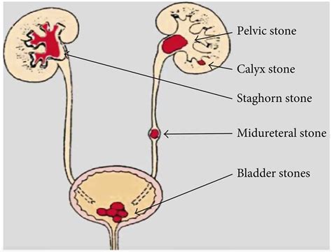 Mapping the Pain: Understanding Kidney Stone Pain Locations