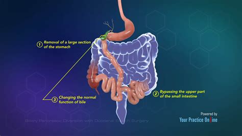 Biliary Pancreatic Diversion with Duodenal Switch Surgery Video ...