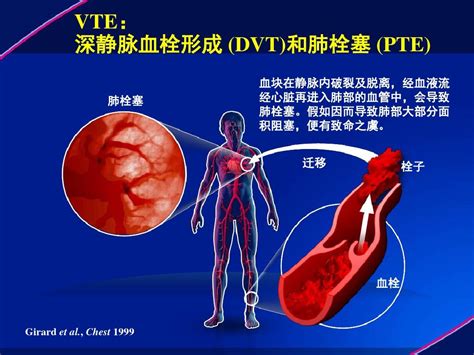 静脉血栓 VTE 防治解读ppt课件 word文档在线阅读与下载 免费文档