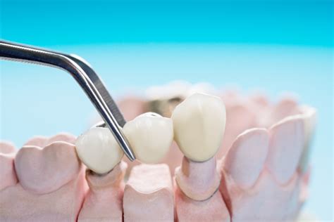 Dental Bridges Can Replace Missing Teeth Smile Design Specialist