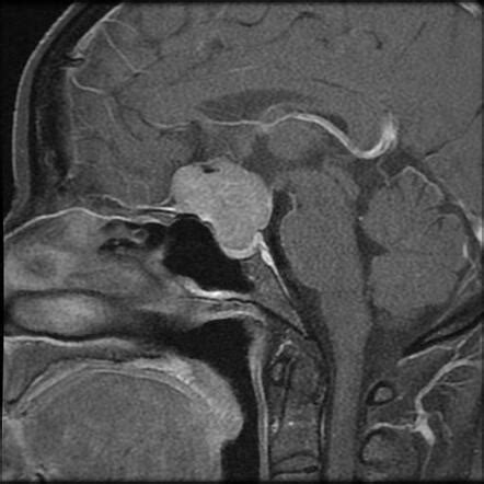 Tuberculum sellae meningioma | Radiology Case | Radiopaedia.org