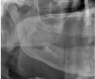 Multiple Keratocystic Odontogenic Tumours Associated With Naevoid Basal