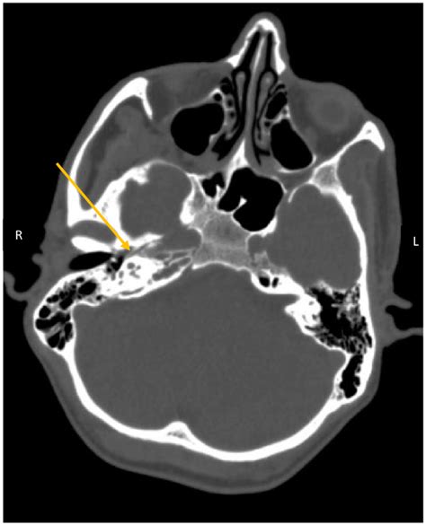 CT Brain (plain) shows suspicion of right sided petrous apicitis and ...