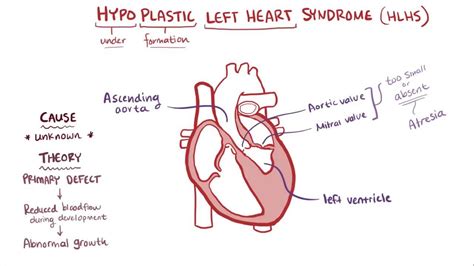 Hypoplastic Left Heart Syndrome Hlhs Causes Symptoms 40 Off