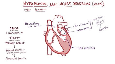 Hypoplastic Left Heart Syndrome (HLHS): Causes, Symptoms, 40% OFF