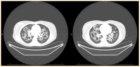 An Atypical And Beautiful Chest Computed Tomography Of Pneumocystis Jiroveci Pneumonia The