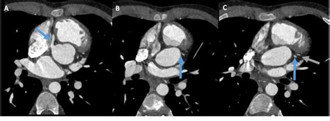 Cardiac Cta Displaying A Normal Course And Filling Of The Rca A Blue